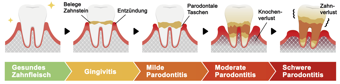 Infografik Stadien der Parodontitis