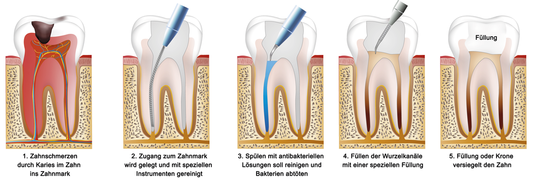 Infografik Wurzelkanalbehandlung